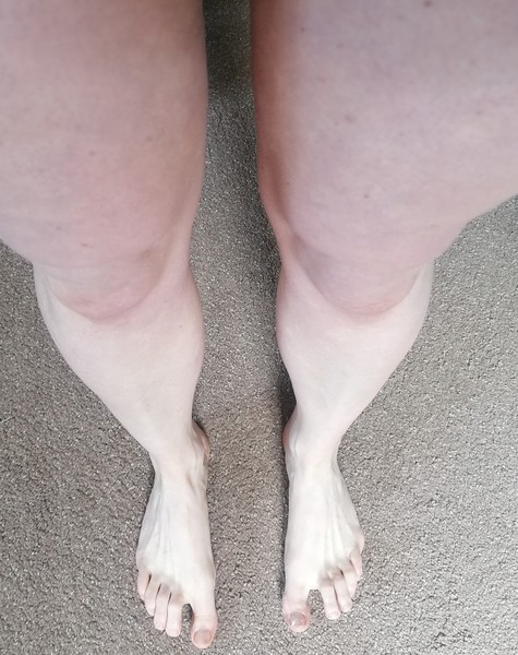 What can I do about my purpleness?