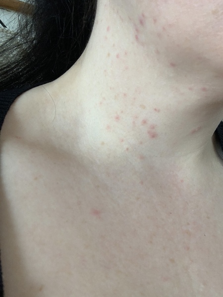 What is this rash?