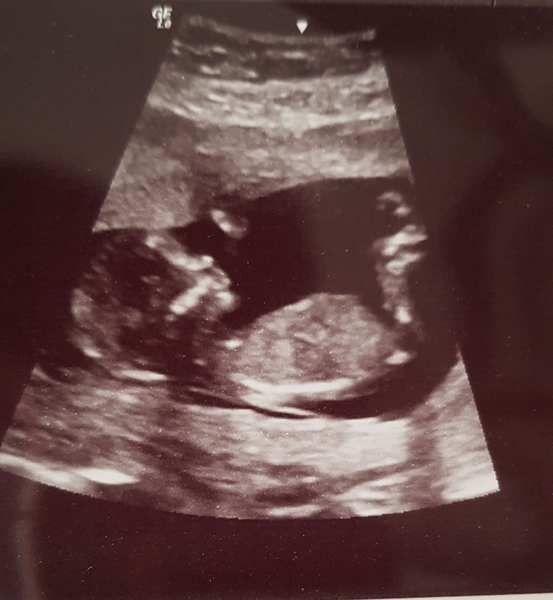 12 week scan time ladies 👣 Pregnancies due Late November/December