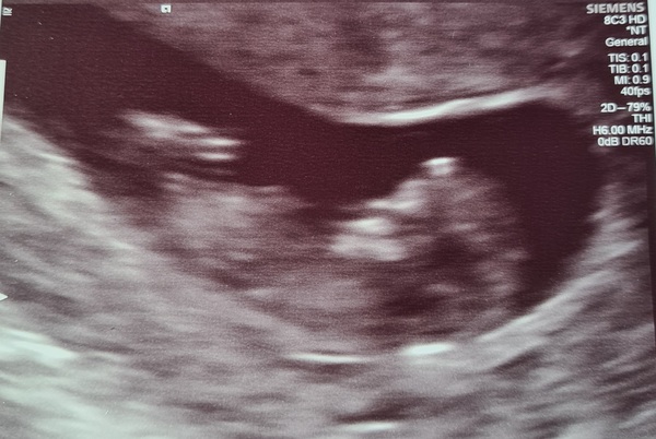Dating scan showed 10 weeks and 3 days. I thought I was 12 weeks!
