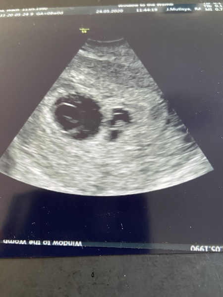 8 weeks scan issues :(