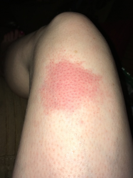 Will this burn leave a scar? Should I use a cream or oil? (Ugly) pic attached