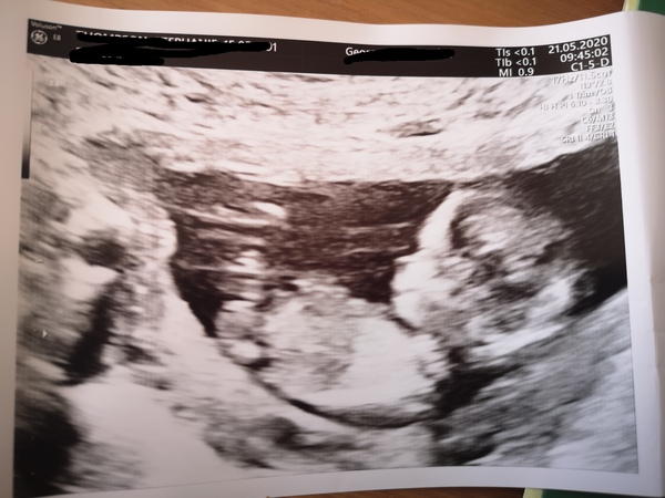 12 week scan time ladies 👣 Pregnancies due Late November/December