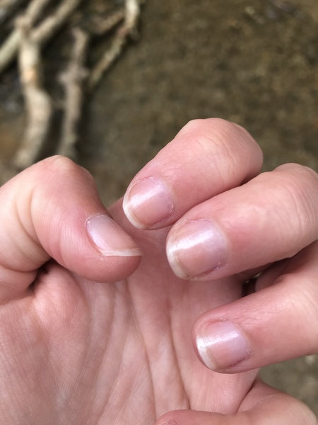 Nail discolouration