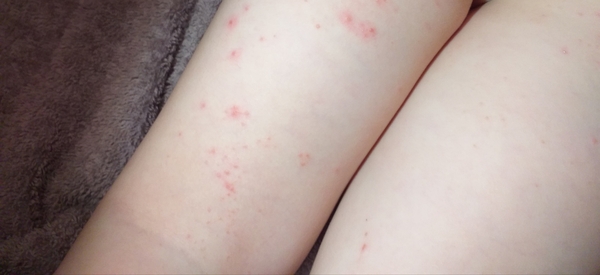 What is this rash? (pic attached)