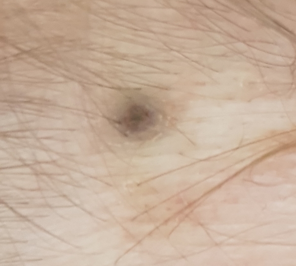 Should I be worried about this mole