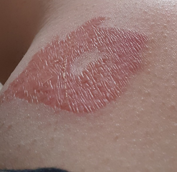 Will this burn leave a scar? Should I use a cream or oil? (Ugly) pic attached
