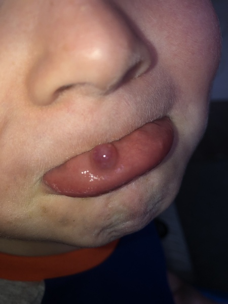 Lump on toddler mouth