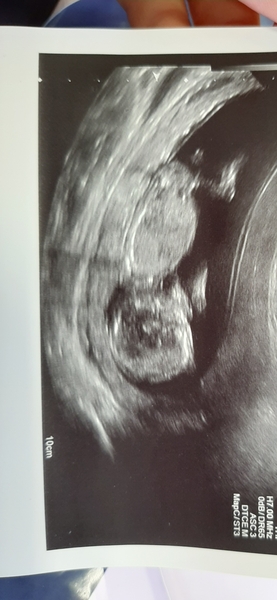 12 week scan time ladies 👣 Pregnancies due Late November/December
