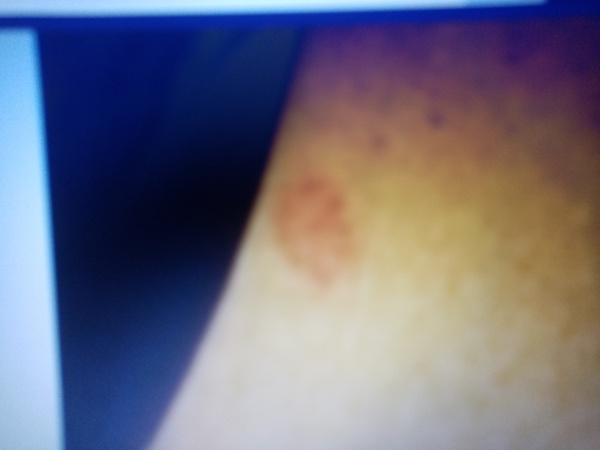 Round red patch
