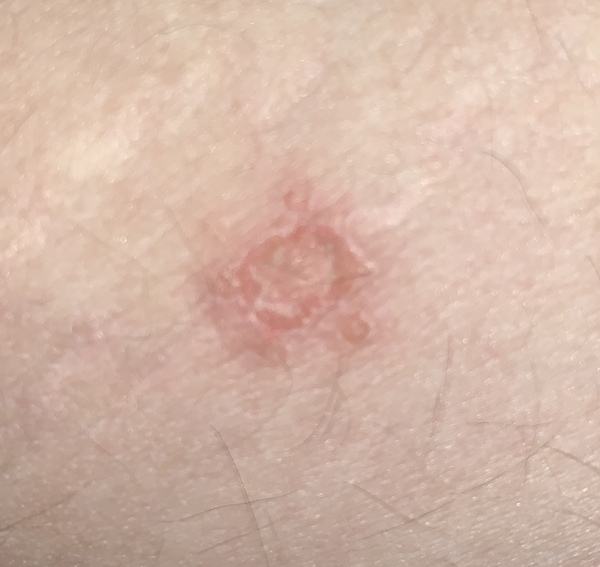 Picture of scabby thing warning. What is it?