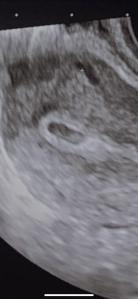 5 weeks pregnant!