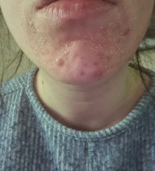 Lymecycline - acne experiences