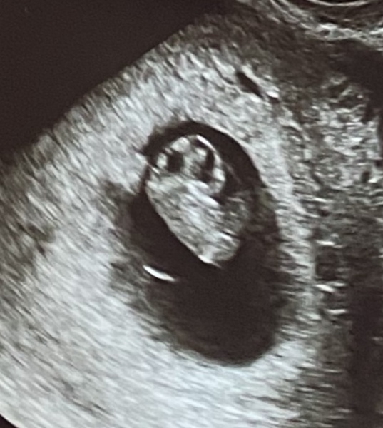 Scan too early - what will you see?