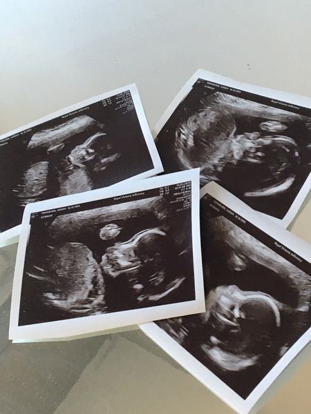 Pregnant after loss and dreaming of rainbows - 3