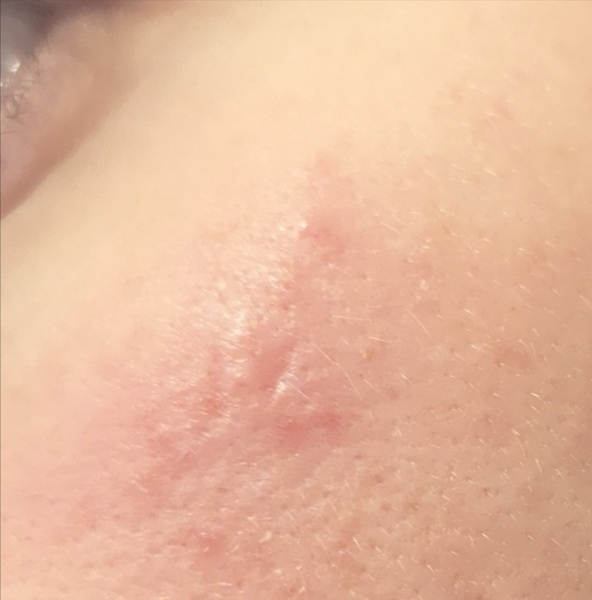 What are these spots on my cheek