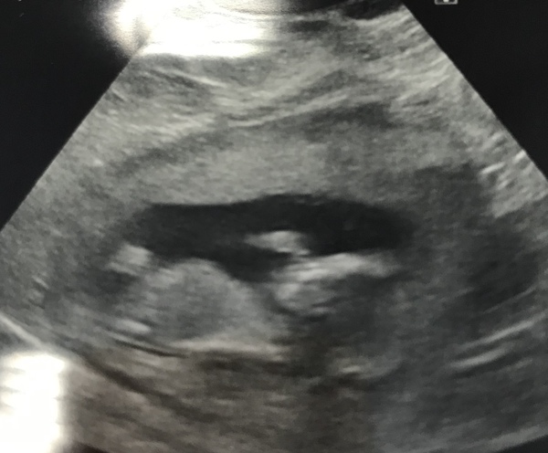 12 week scan time ladies 👣 Pregnancies due Late November/December