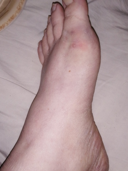 Should I go to the doctor with this - bruise on base of toe
