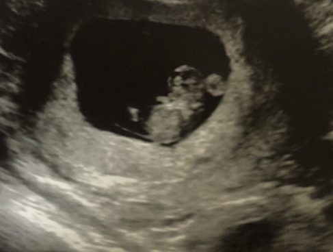 10 week scan worry