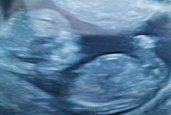 12 week scan time ladies 👣 Pregnancies due Late November/December