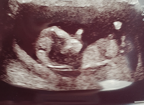 12 weeks scan during covid19