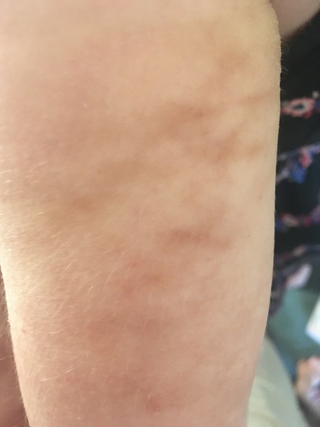 To phone 111 with weird new rash on adult?