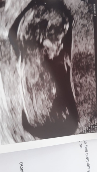 Nub-less baby :-/   (Where's the frickin's nub?!)
