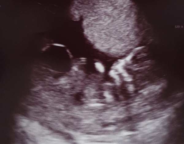 12 week scan time ladies 👣 Pregnancies due Late November/December