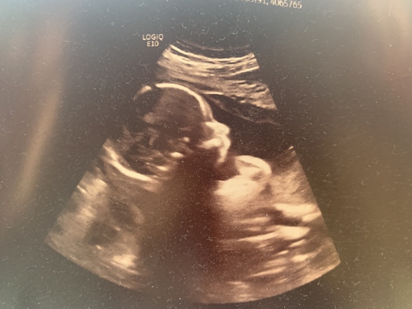 Skull theory on my scan