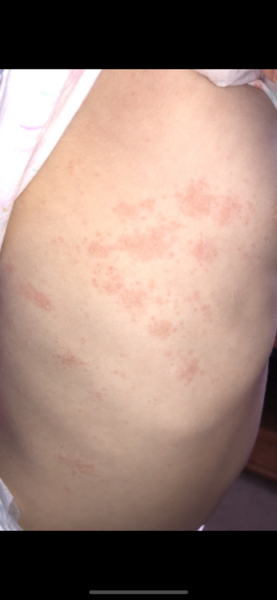 Rash on toddler
