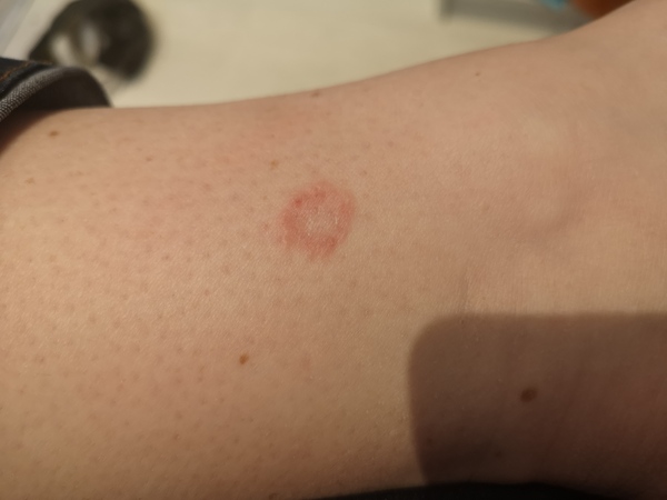 What's this rash?