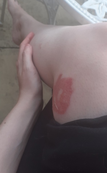 Will this burn leave a scar? Should I use a cream or oil? (Ugly) pic attached