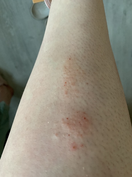 Itchy patch