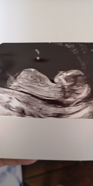 14 week scan gender guess x