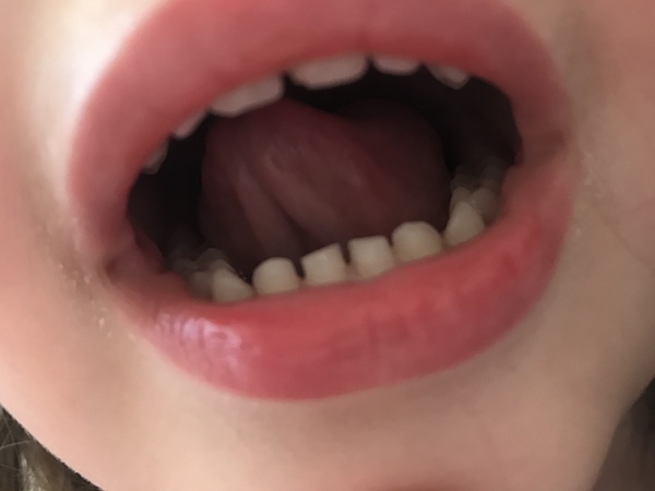 DD age 3 has chipped her front tooth! Any dentists on here?
