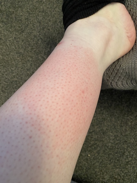 What bite is this? Pic included