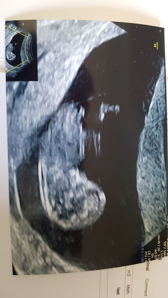 IVF Feb/March 2