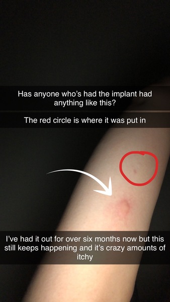 Weird lump where implant is