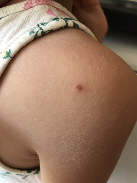 HELP!! DD’s tick bite *pic attached