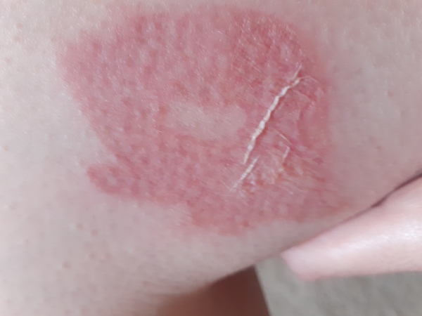 Will this burn leave a scar? Should I use a cream or oil? (Ugly) pic attached