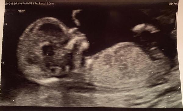 12 week scan today- feeling apprehensive