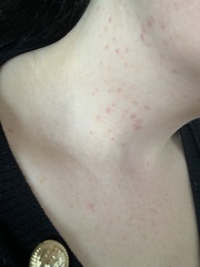 Name the rash - pic included
