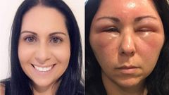 Dyeing hair for first time at home -patch test