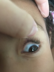 What is this on the whites of DDs eye (pic)
