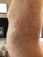 Horrendous rash. Docs stumped. Ideas?