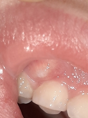 WARNING  - PHOTOS!  Attention dentists  - what is this on DD's gum?