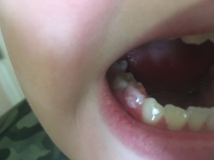 Pink tooth after injury