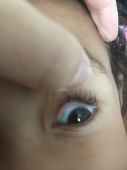 What is this on the whites of DDs eye (pic)