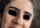 Nose job for bulbous thick skin nose