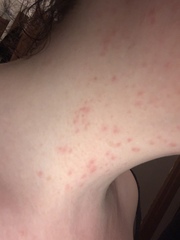 Name the rash - pic included